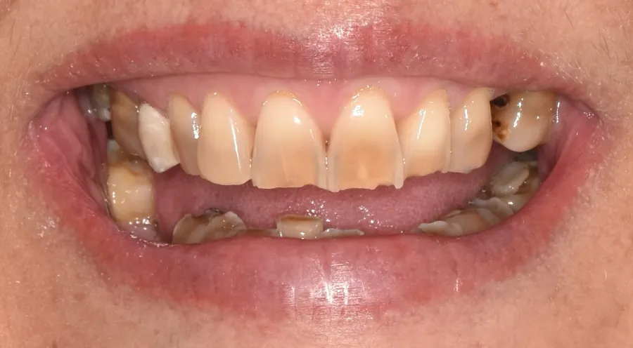Antes: carillas dentales